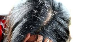 وصفة طبيعية لعلاج قشرة الشعر بشرط المواظبة عليها - موقع رادار