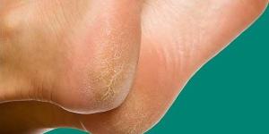 الجلد على القدمين يشير إلى الإصابة بسرطان المريء - موقع رادار