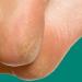 الجلد على القدمين يشير إلى الإصابة بسرطان المريء - موقع رادار